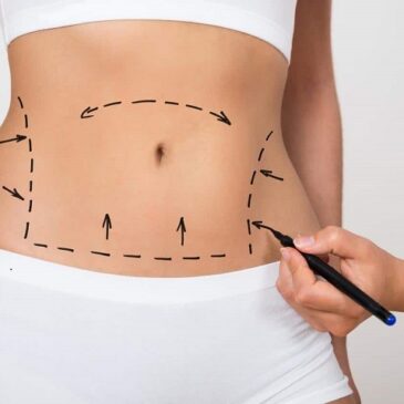 La lipoaspiration : tout ce qu&rsquo;il faut savoir !